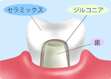 ラミネートベニア