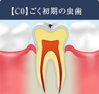 【C0】ごく初期のむし歯