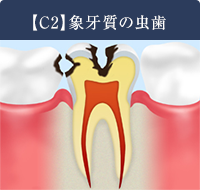 【C2】象牙質のむし歯