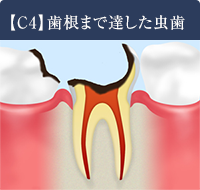 【C4】歯根まで達したむし歯